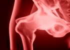Koxartróza a artrózy iných kĺbov